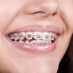 The best doctor for braces in Egypt
