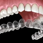The best doctor for clear braces