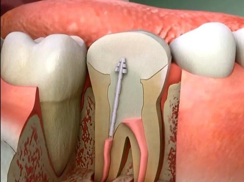 Root Canal Treatment