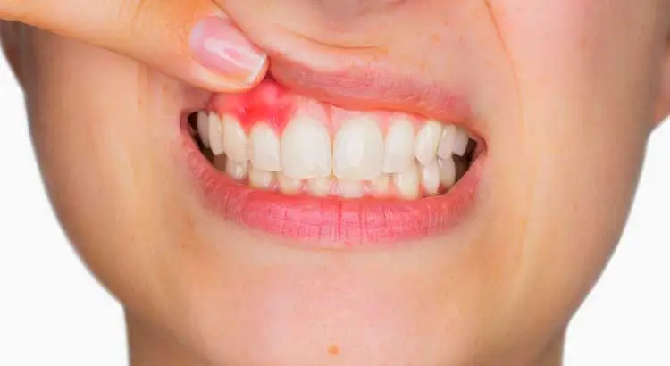 Gum Treatment