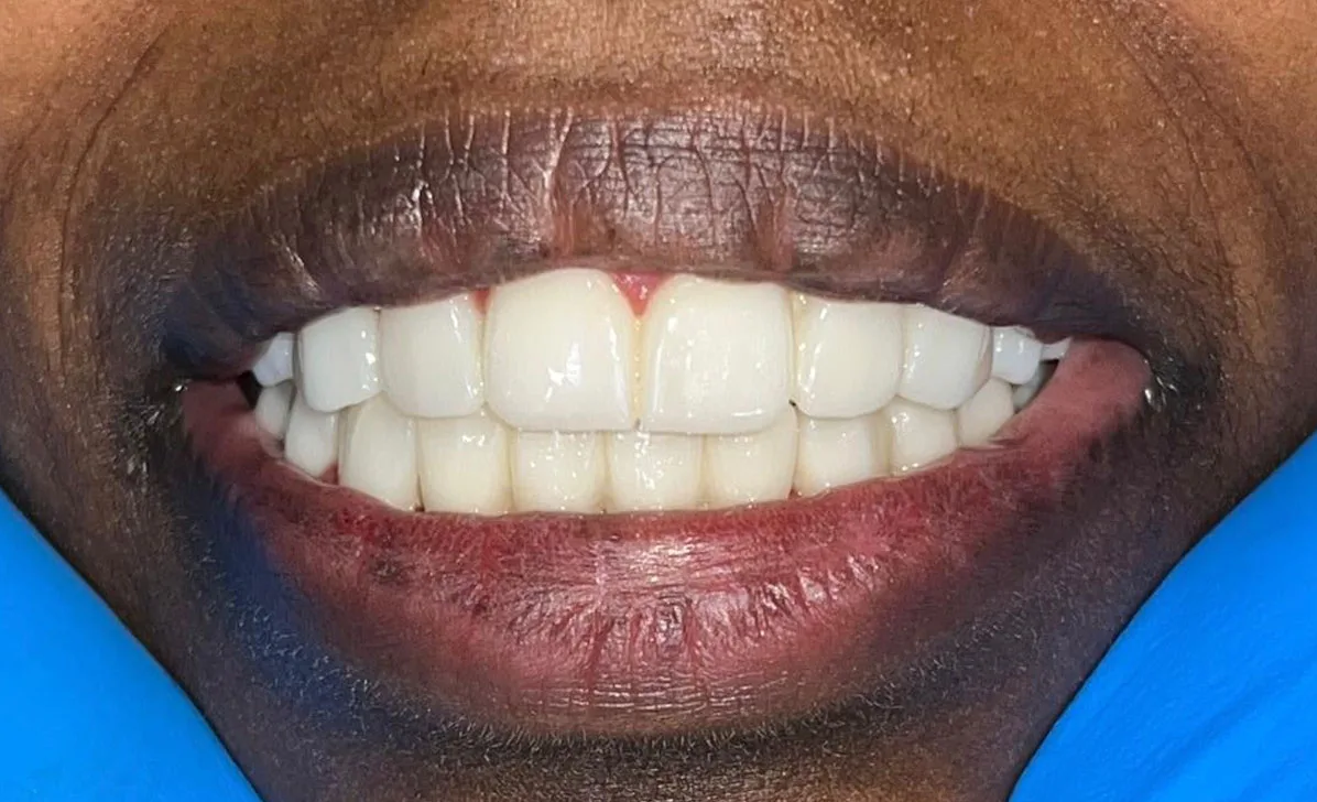After treatment