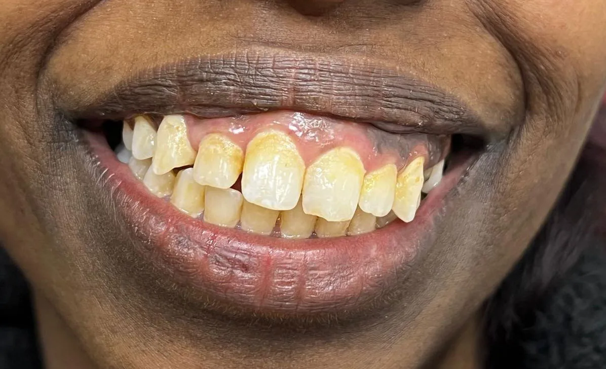 Before treatment