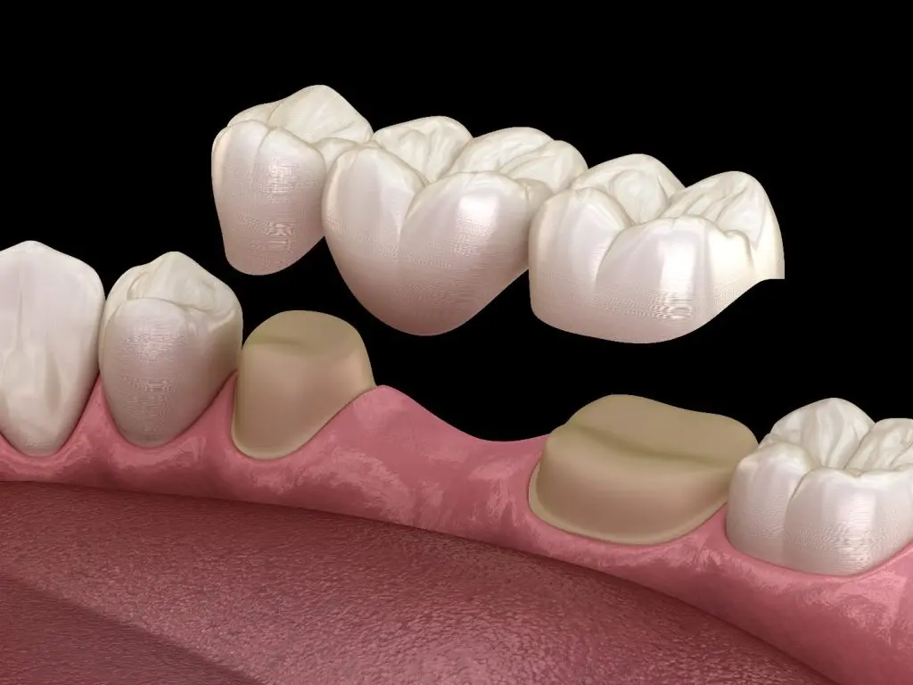 Fixed Dental Restorations