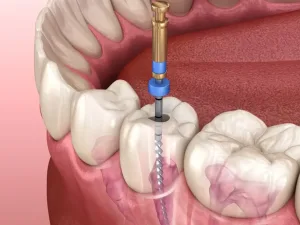 Professional Root Canal Treatment
