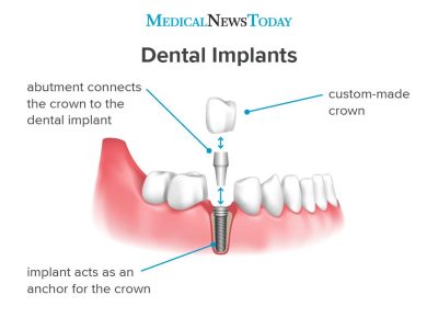 an-infographic-showing-how-dental-implants-work